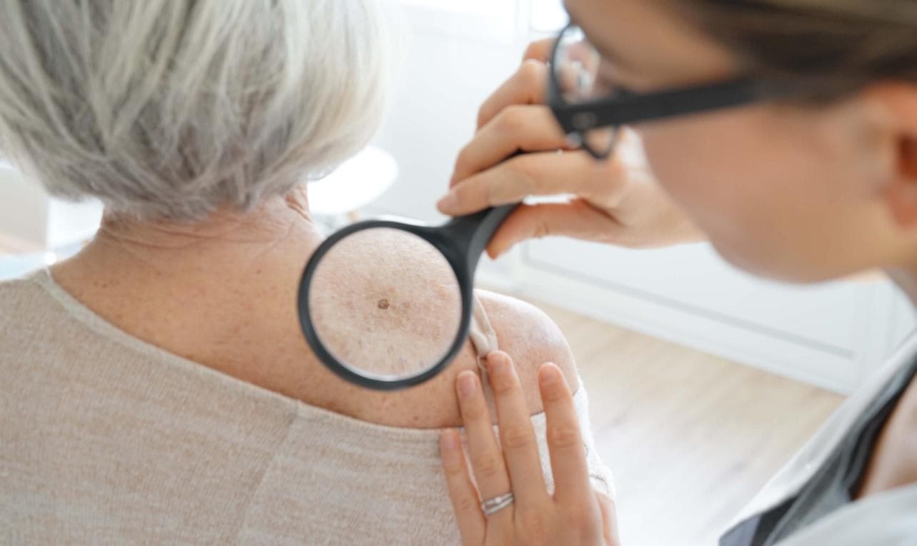 FDA approves skin cancer AI detection device