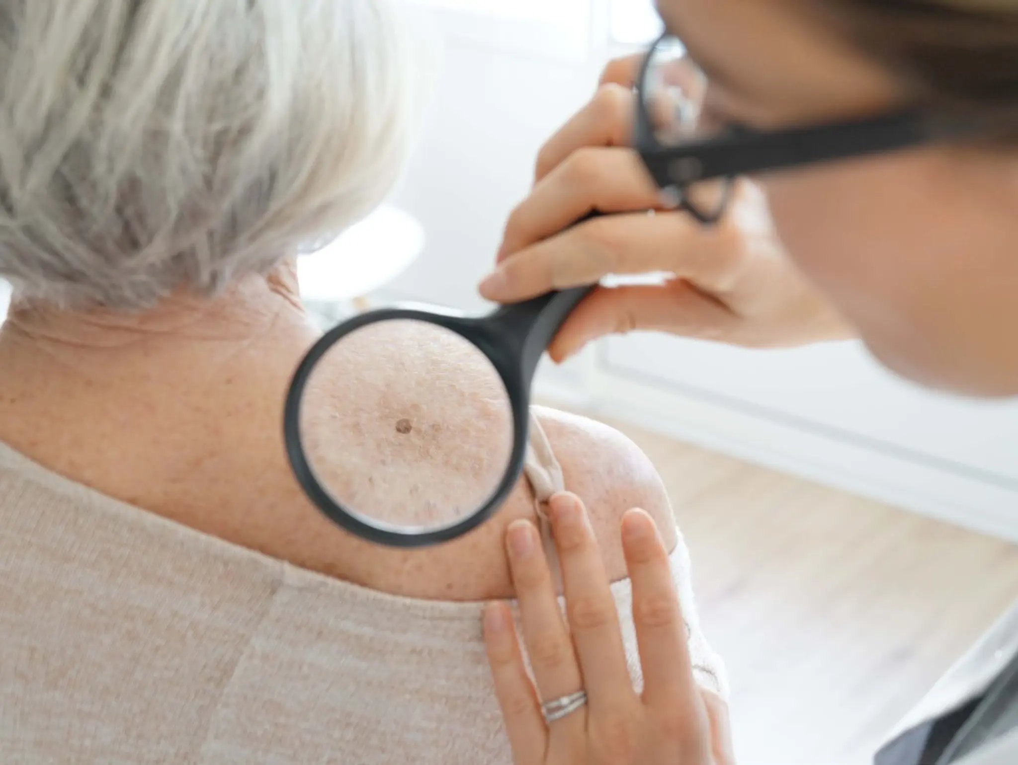 FDA approves skin cancer AI detection device