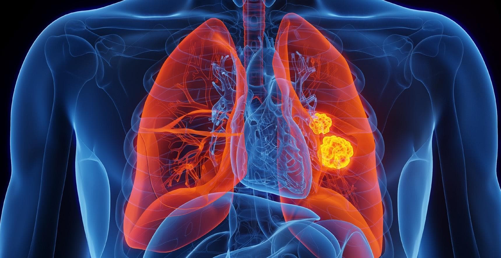 FDA grants Fast Track Designation for Verastem’s combination NSCLC treatment