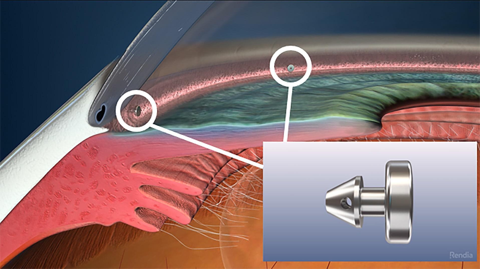 Glaucoma and Ocular Surface Disease