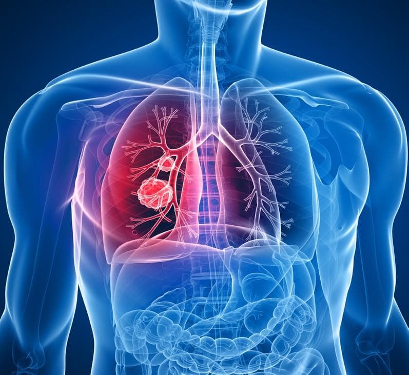 FDA approves AstraZeneca’s Tagrisso for lung cancer treatment