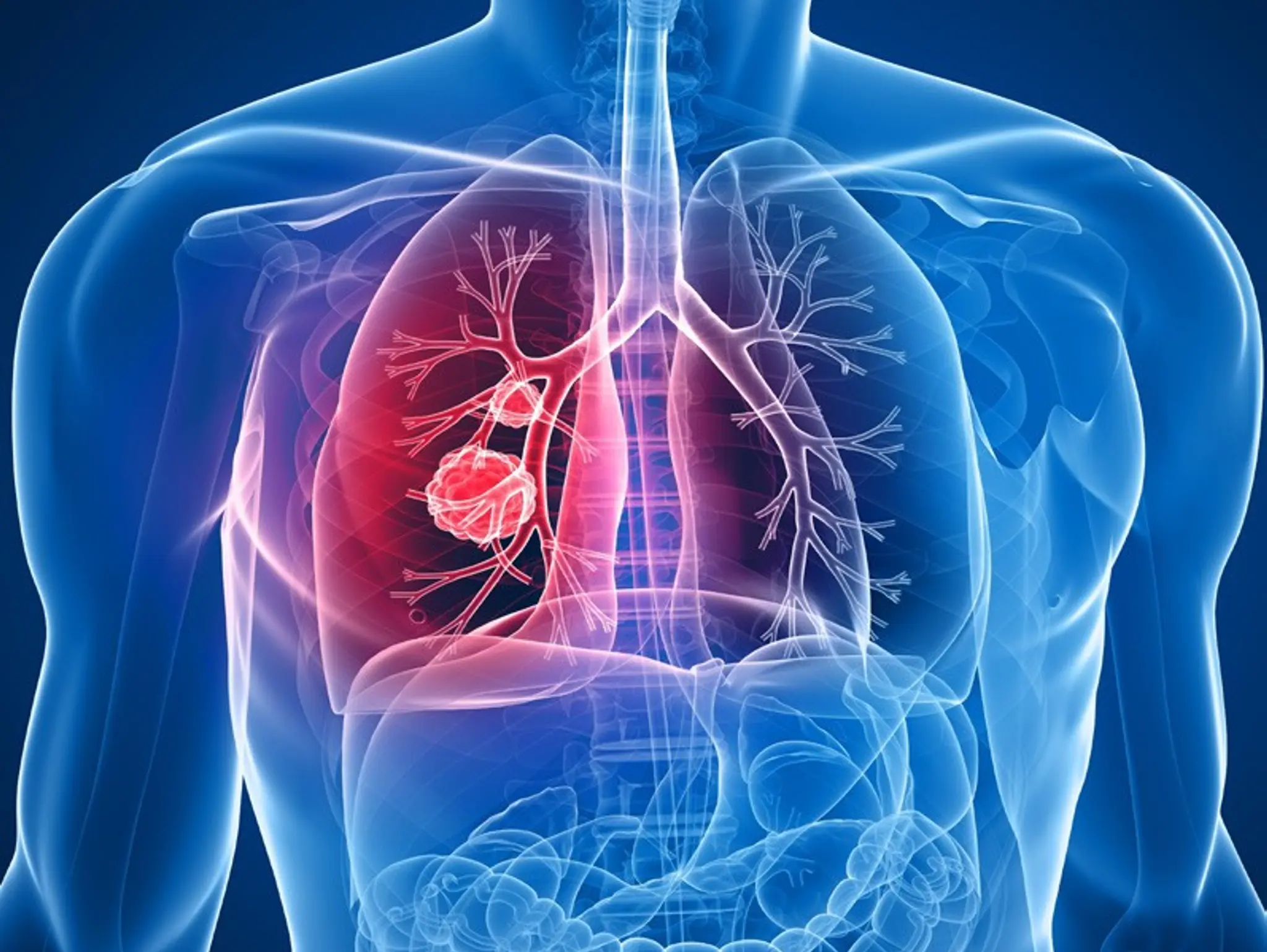 FDA approves AstraZeneca’s Tagrisso for lung cancer treatment