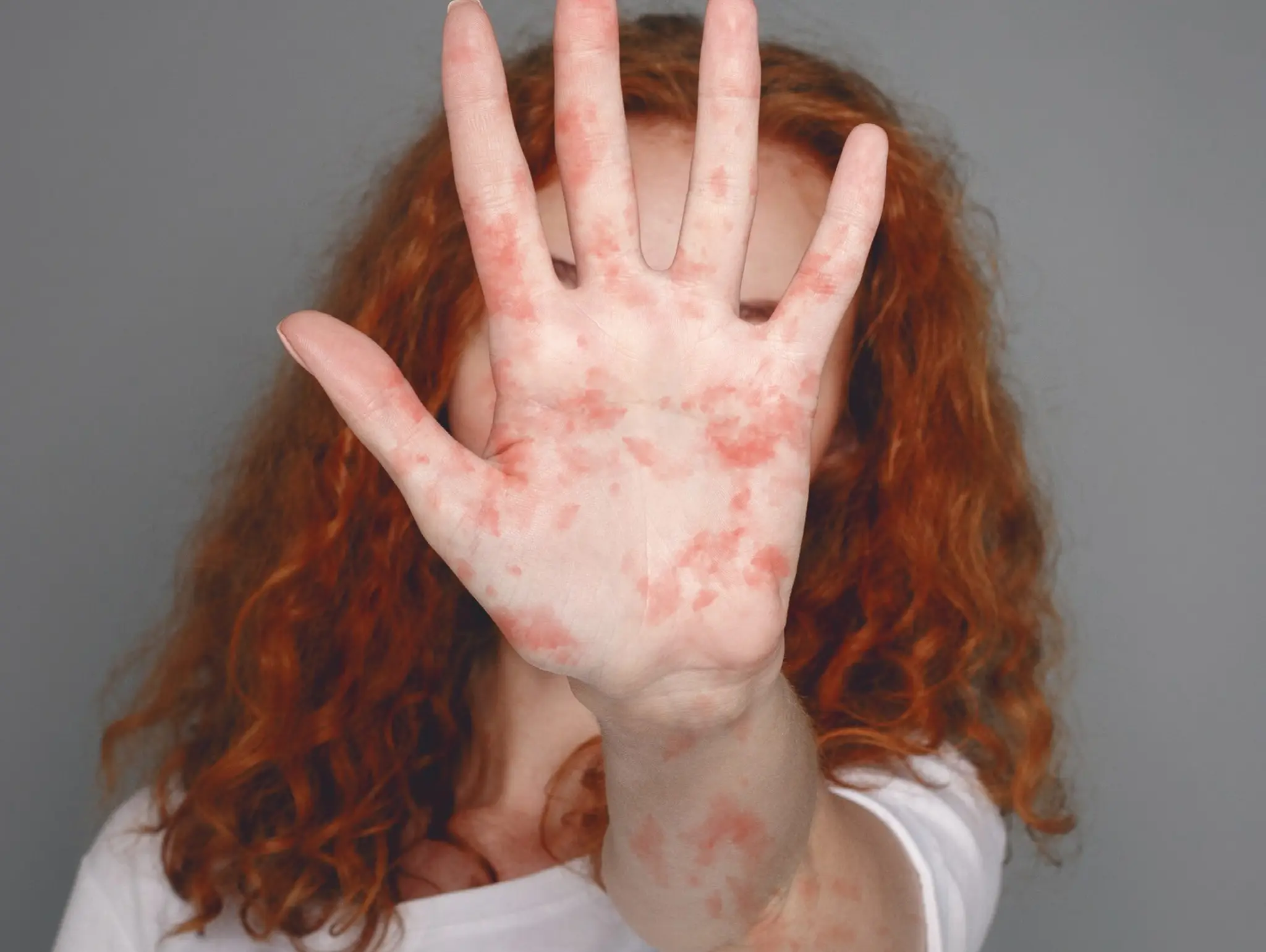 Five facts about measles