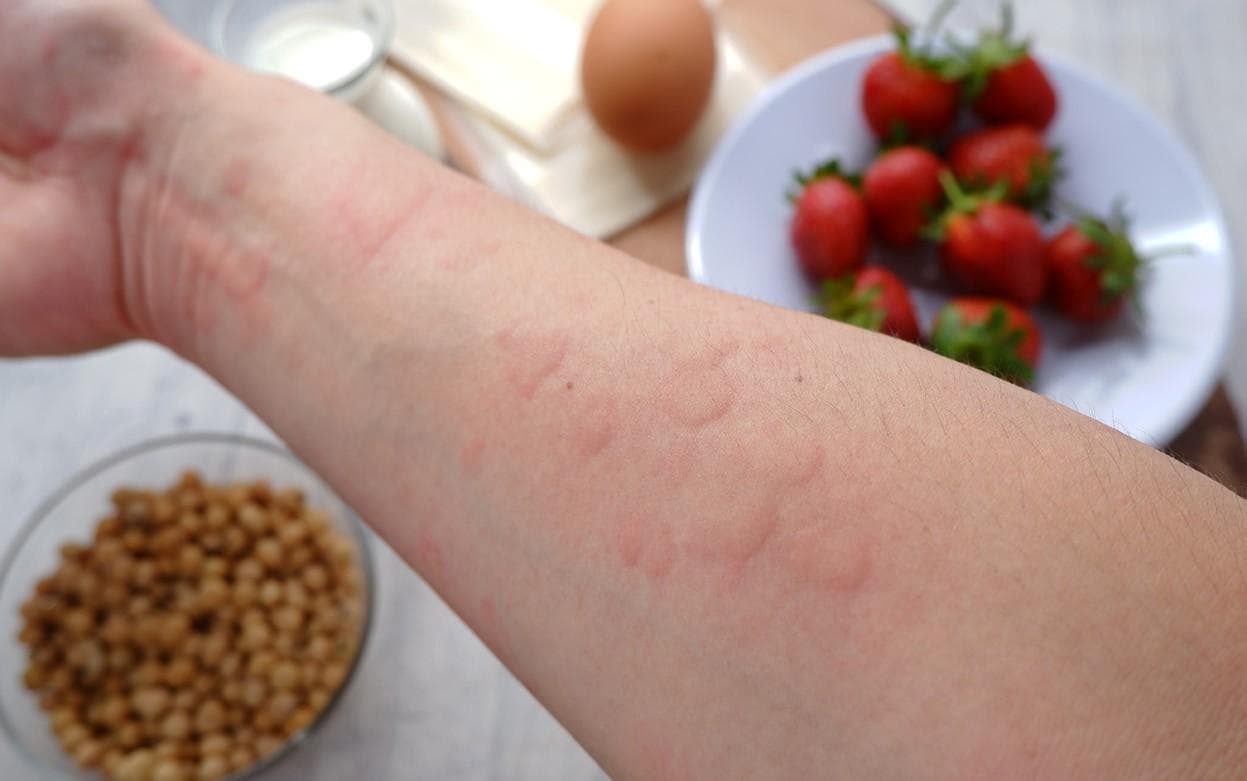 Roche announces results from phase 3 study of allergy treatment, Xolair