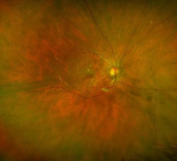 Drought Breaker: New GA Treatments to Impact Optometry