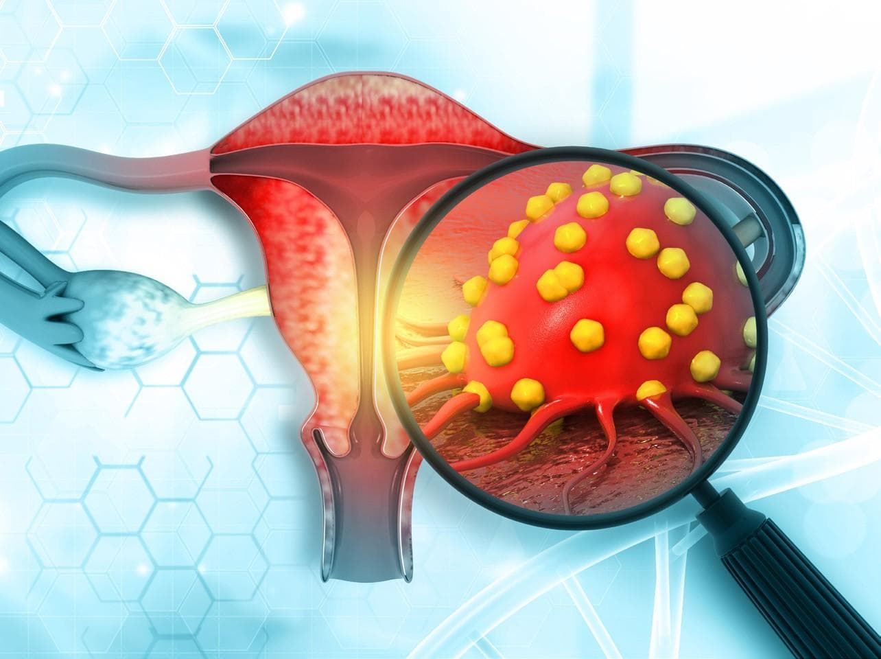 GSK announces data from phase 3 trial for Jemperli combinations for endometrial cancer