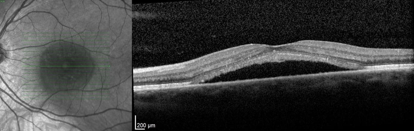 Central Serous Chorioretinopathy: Evolving Understanding, Investigations, and Treatment Options