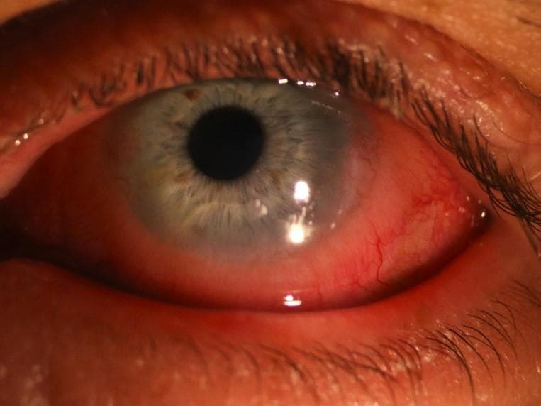 Finessing the Fit: Scleral Lenses for Keratoconus