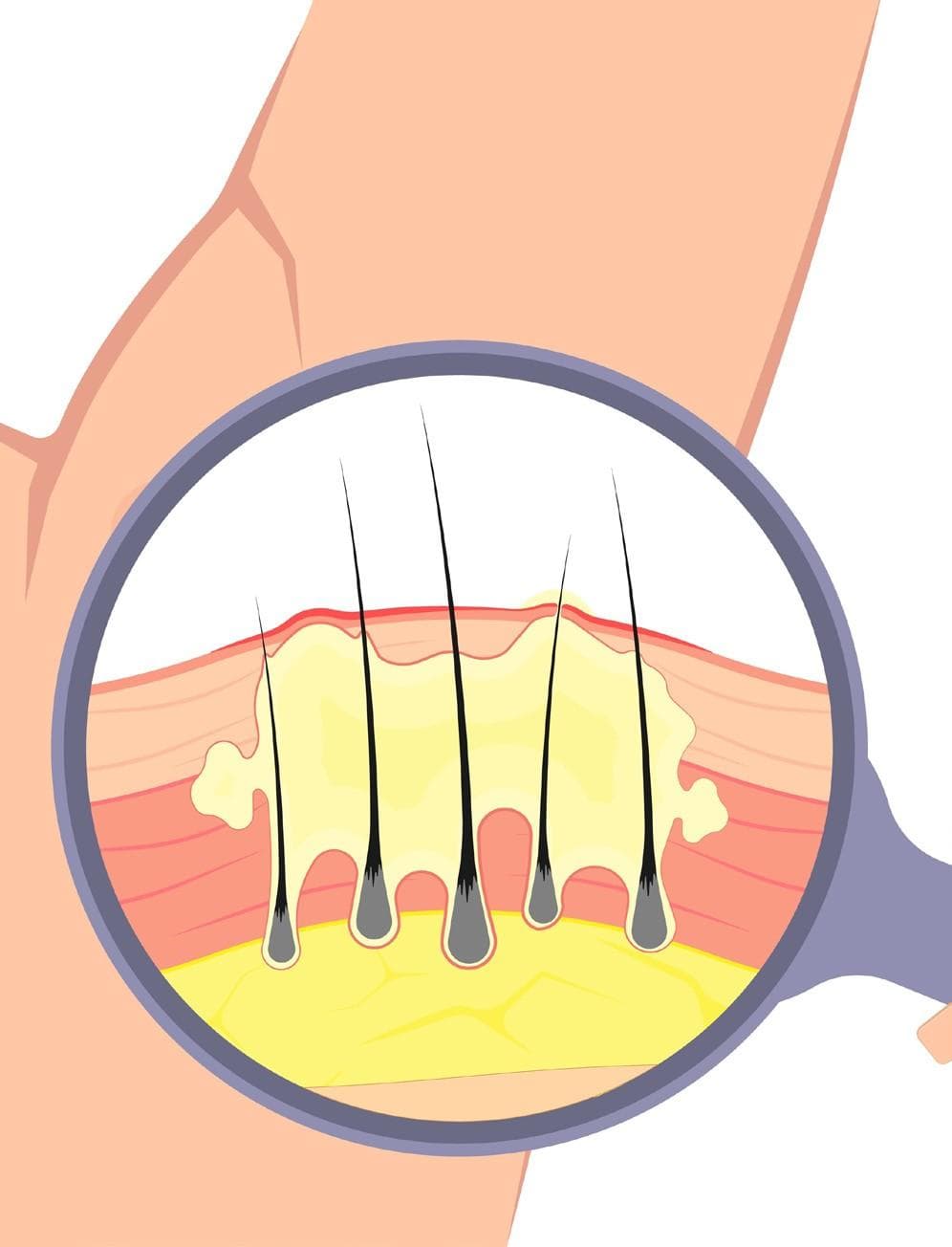 UCB’s sBLA for Bimzelx accepted by FDA for HS treatment