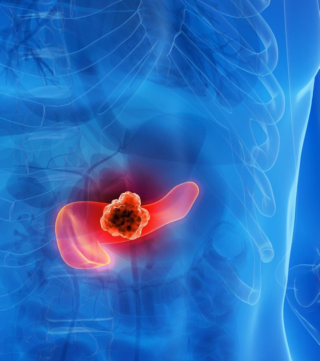 Candel Therapeutics’ pancreatic cancer treatment granted ODD by FDA