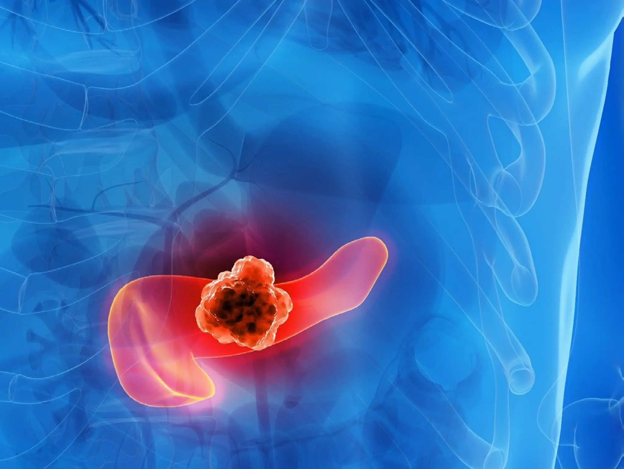 Candel Therapeutics’ pancreatic cancer treatment granted ODD by FDA