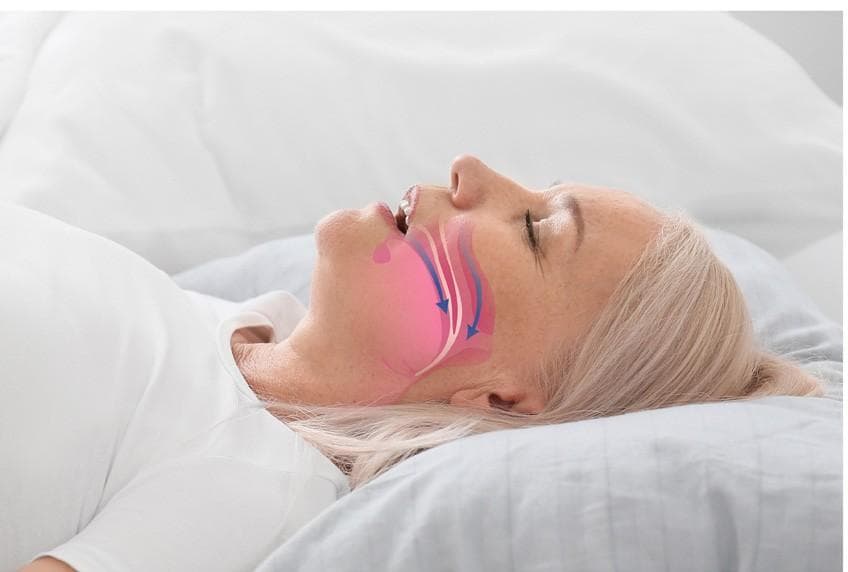 Eli Lilly shares results from phase 3 trial for tirzepatide in reducing sleep apnoea severity