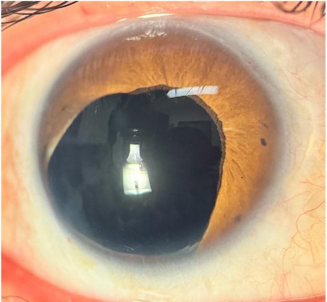 Anterior Segment Reconstruction: Techniques and Tips for Optimum Outcomes