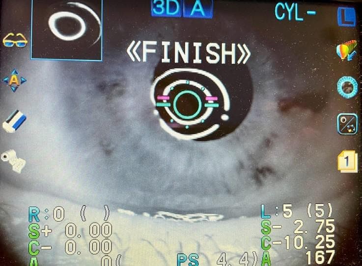 Keratoconus: Detection and Management