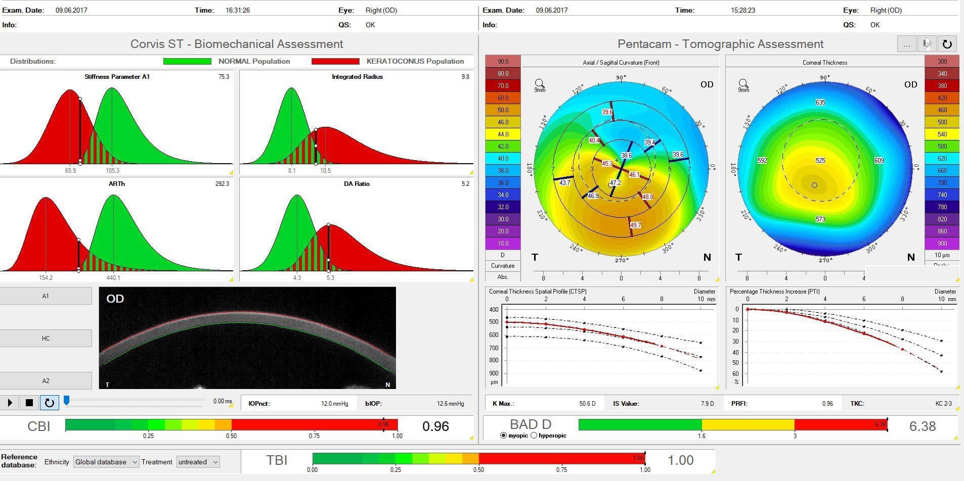 Corneal Biomechanics in Anterior Segment Disease & Refractive Surgery Screening