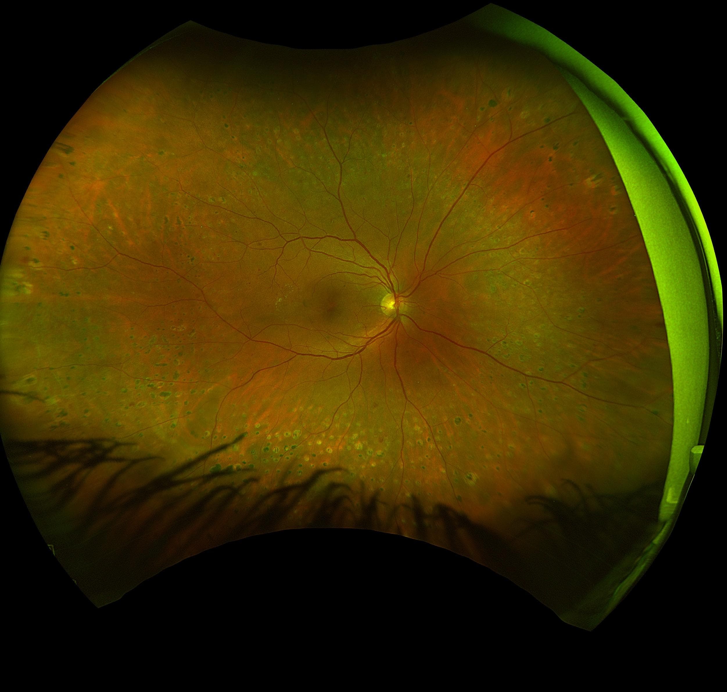 Revolutionising Diabetes Management