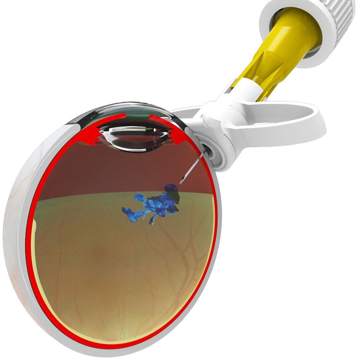 Intravitreal Injections: Building Sustainability into Disease Treatment