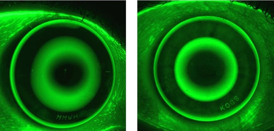 Orthokeratology Customisation: A Necessity for Myopia Control?