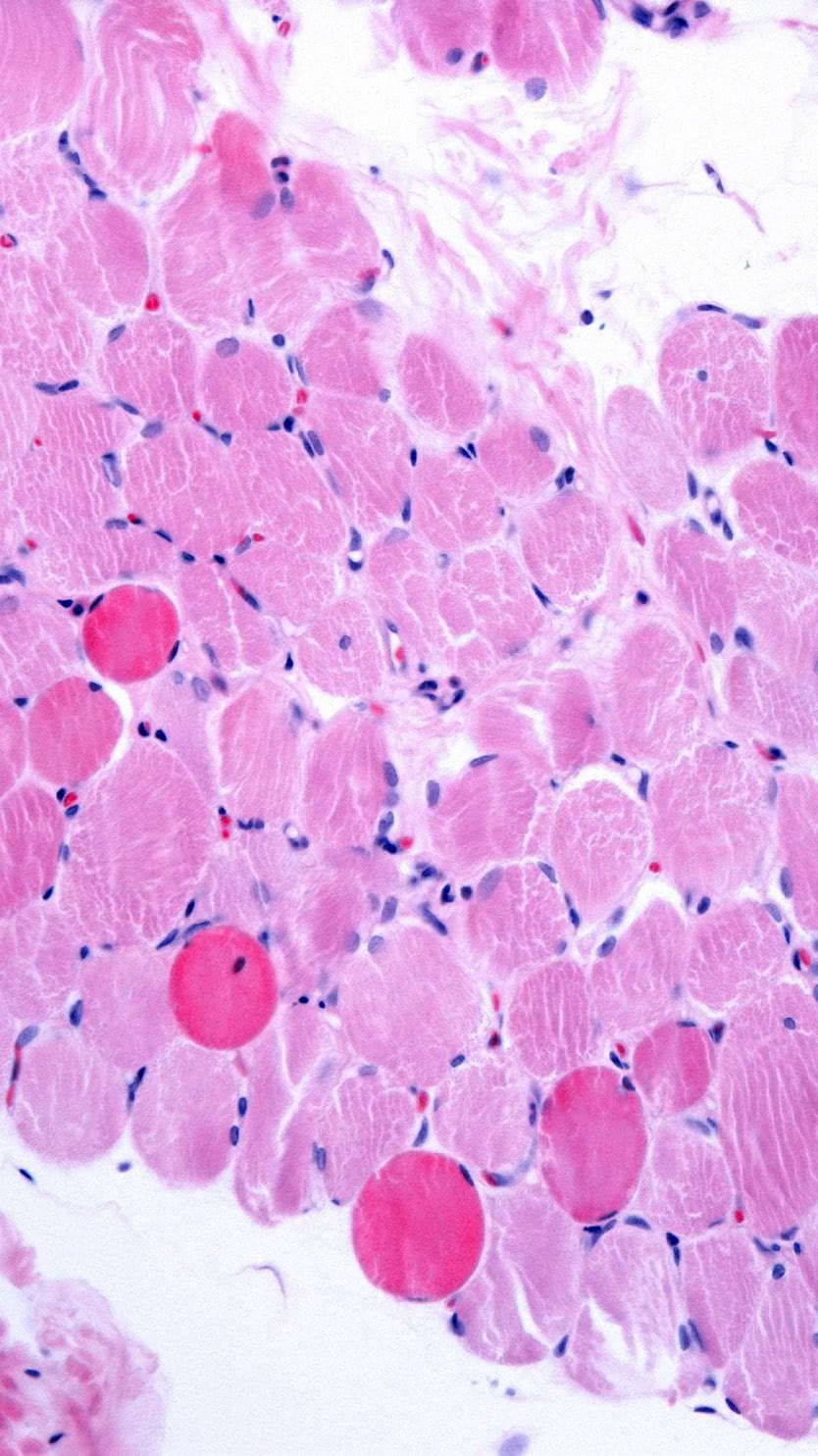 FDA expands approval for Sarepta Therapeutics’ DMD treatment