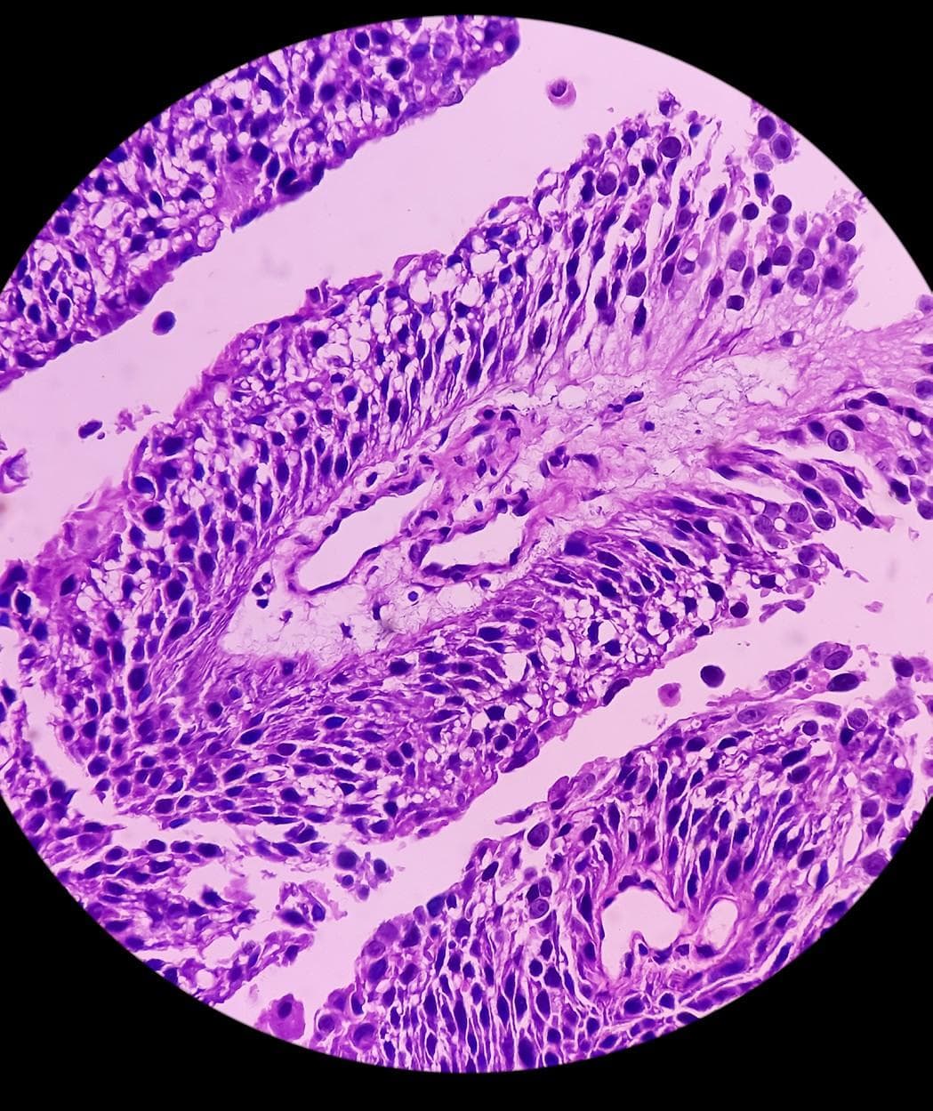 CHMP gives positive opinion for Merck’s KEYTRUDA for unresectable or metastatic urothelial carcinoma