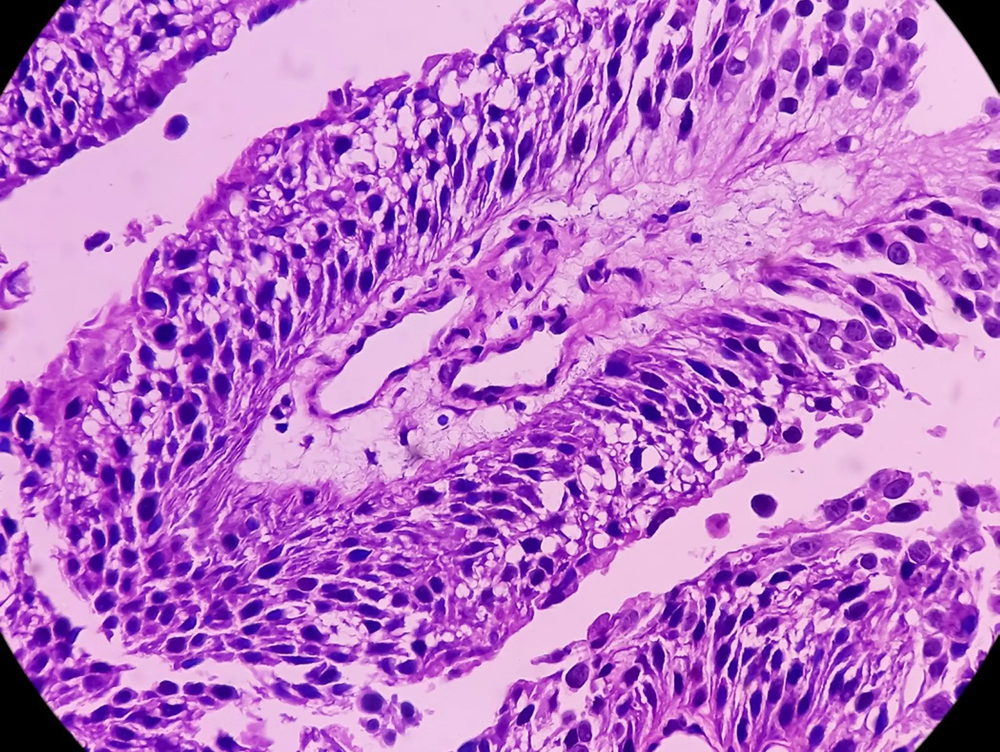 CHMP gives positive opinion for Merck’s KEYTRUDA for unresectable or metastatic urothelial carcinoma