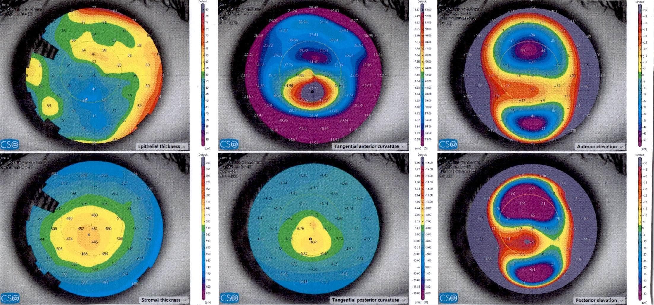 Epithelial OCT Mapping: A Crucial Tool for Refractive Surgeons