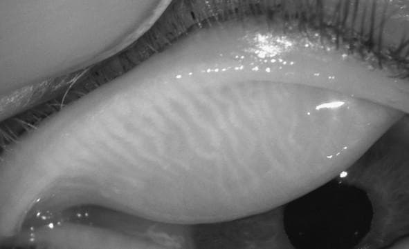 Resisting the New Normal of Dry Eye Disease