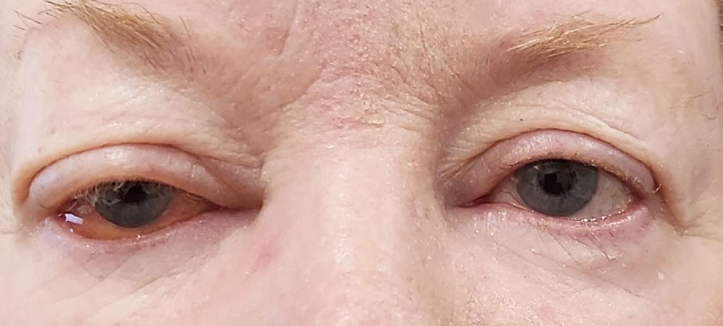 Co-managing Cataract Patients Red Flags for the First 30 Days