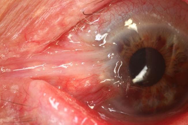 Perfecting the Art of Pterygium Surgery