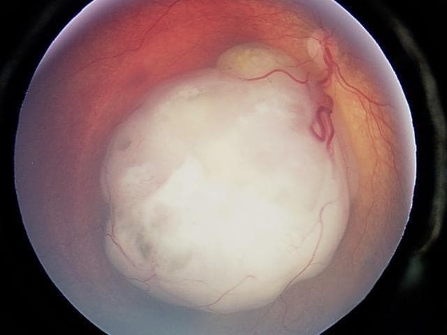 Paediatric Strabismus: Exploring Eight Myths