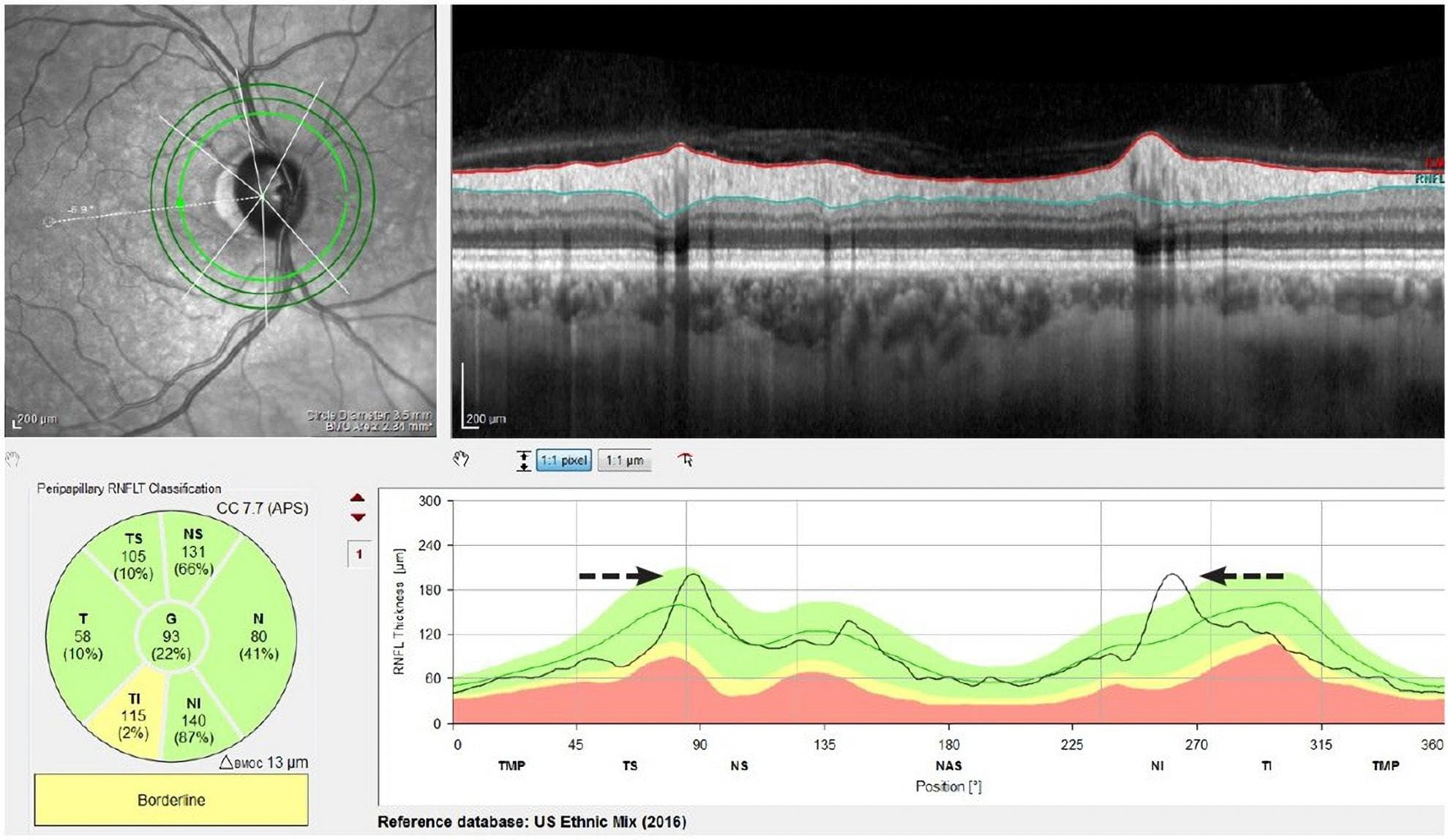 Glaucoma, Imaging, and OCT