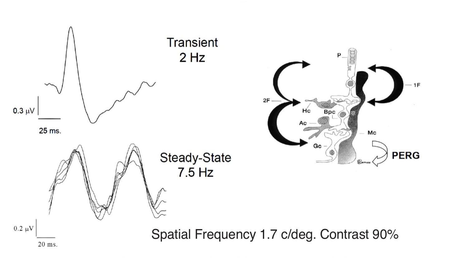Pattern Electroretinogram Testing for Retinal Ganglion Cell Dysfunction