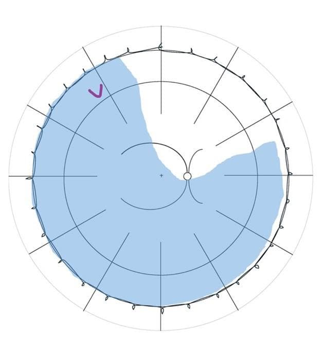 Rhegmatogenous Retinal Detachment: Updating Our Management Approach