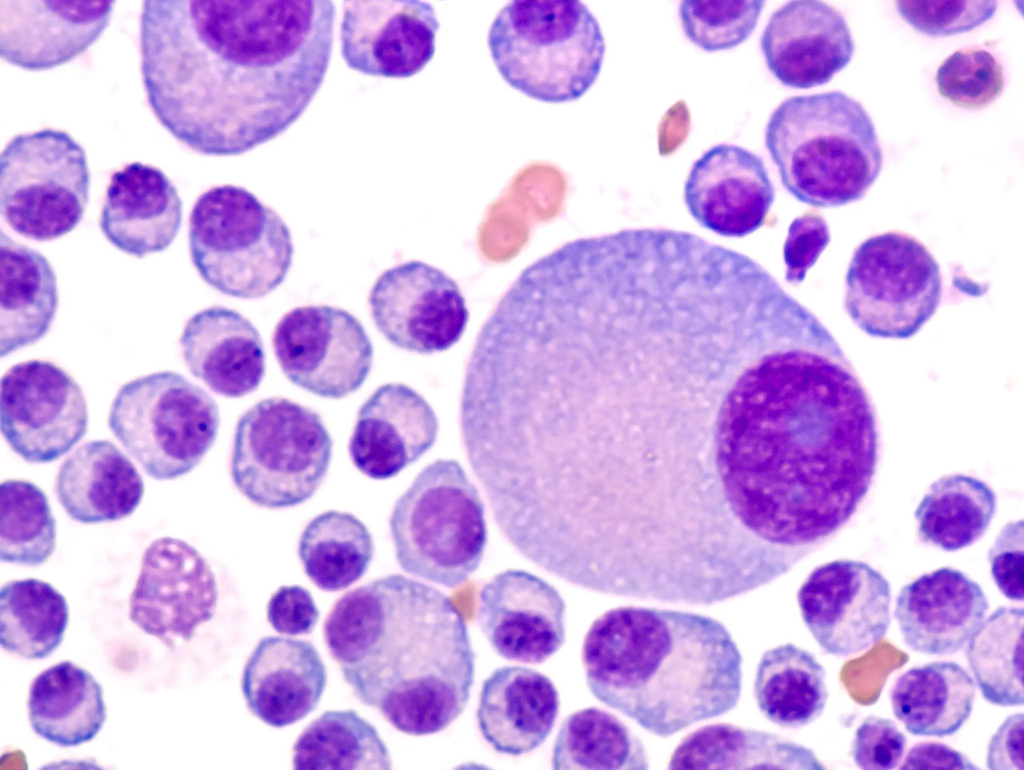 Johnson & Johnson’s Darzalex gains boost over conventional chemotherapy