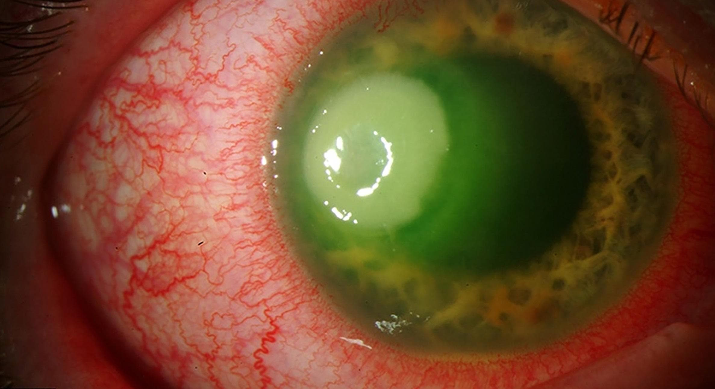 Infectious Keratitis