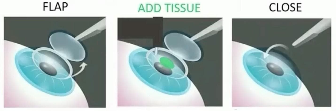 Allotex Allogenic Corneal Inlays