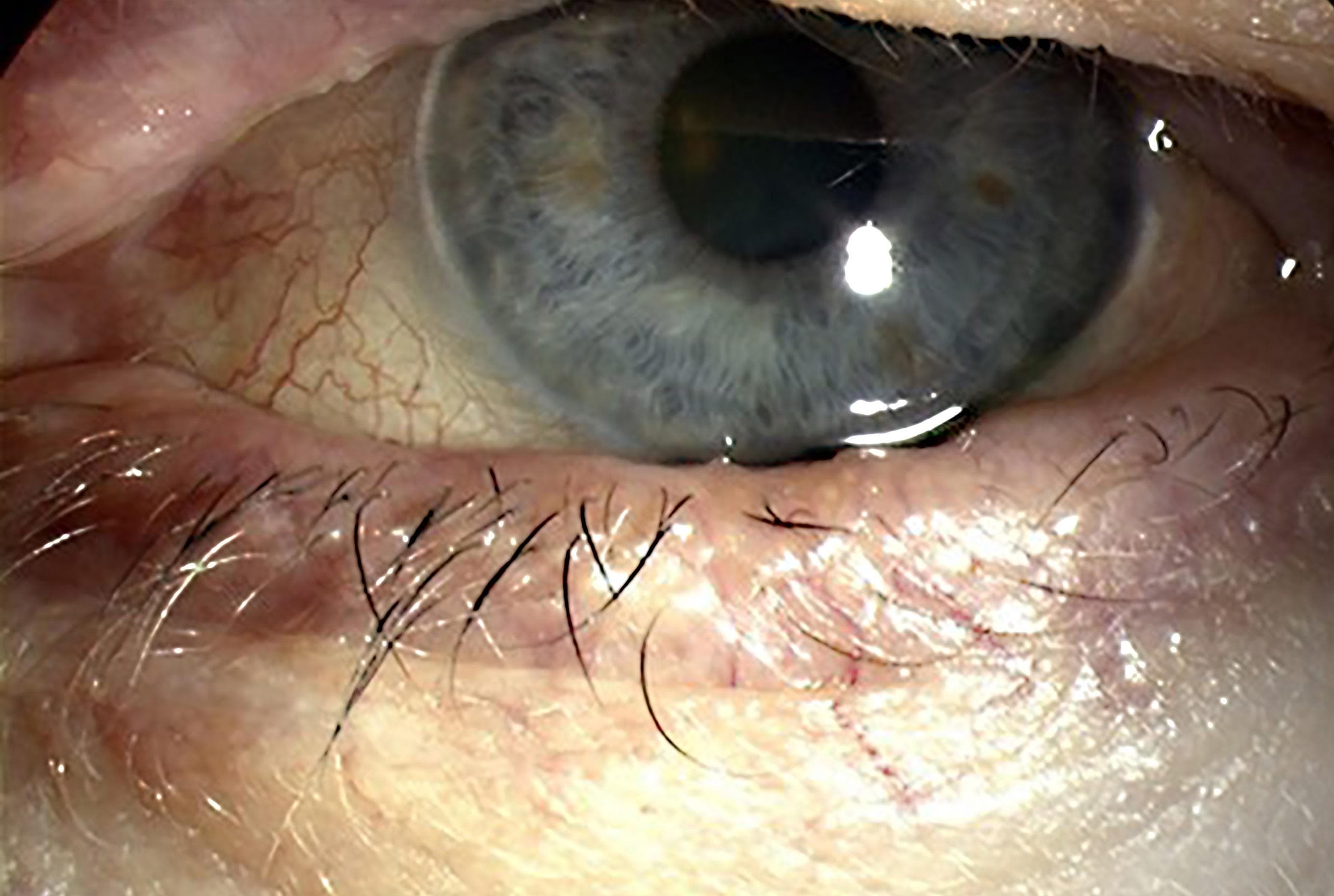 Effect of Topical Ciclosporin Reviewed
