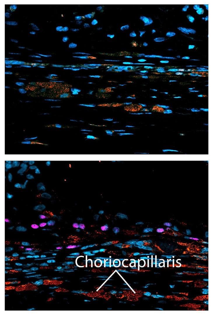 RPE Tissue Grafts for Dry AMD