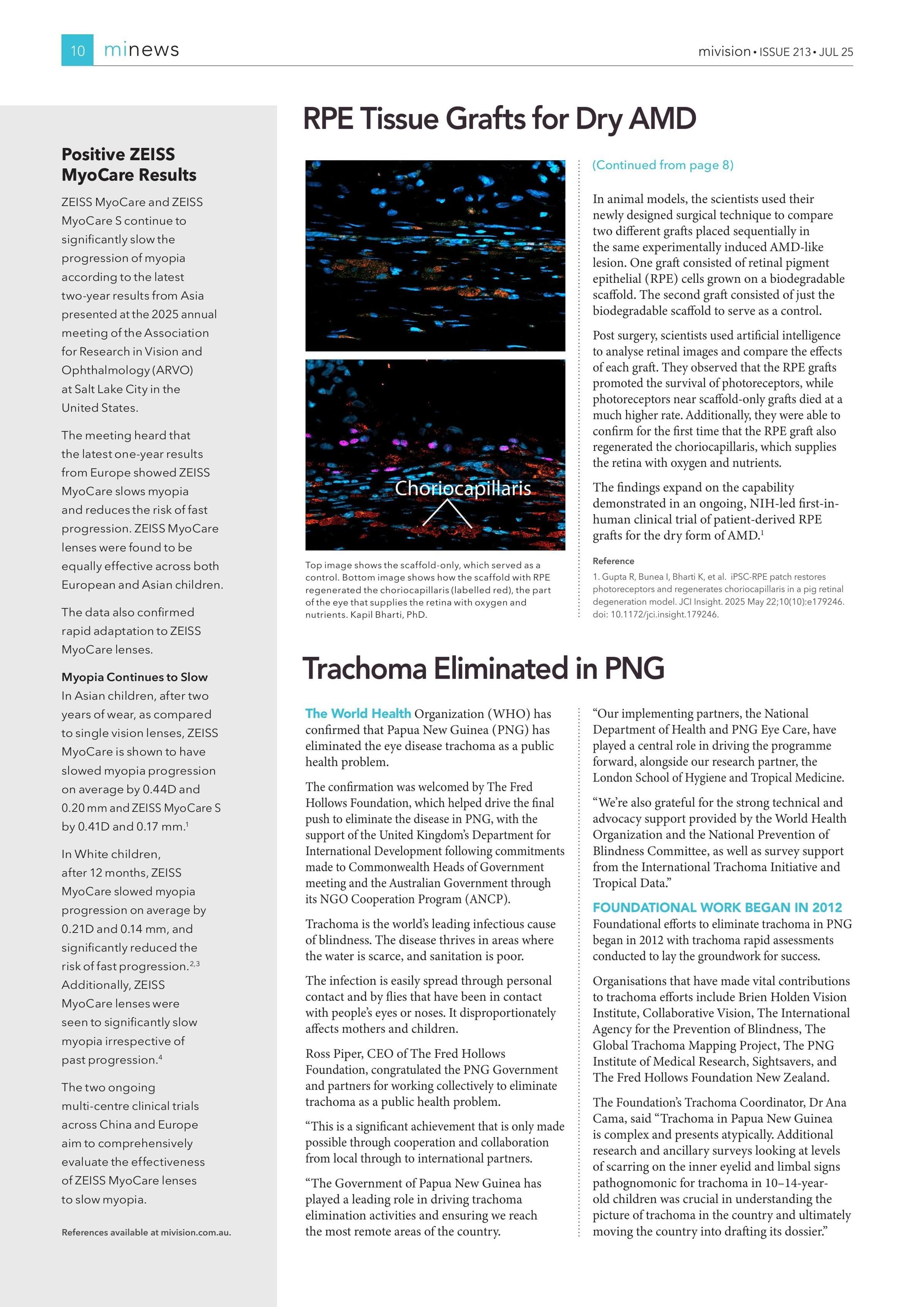Positive ZEISS MyoCare Results