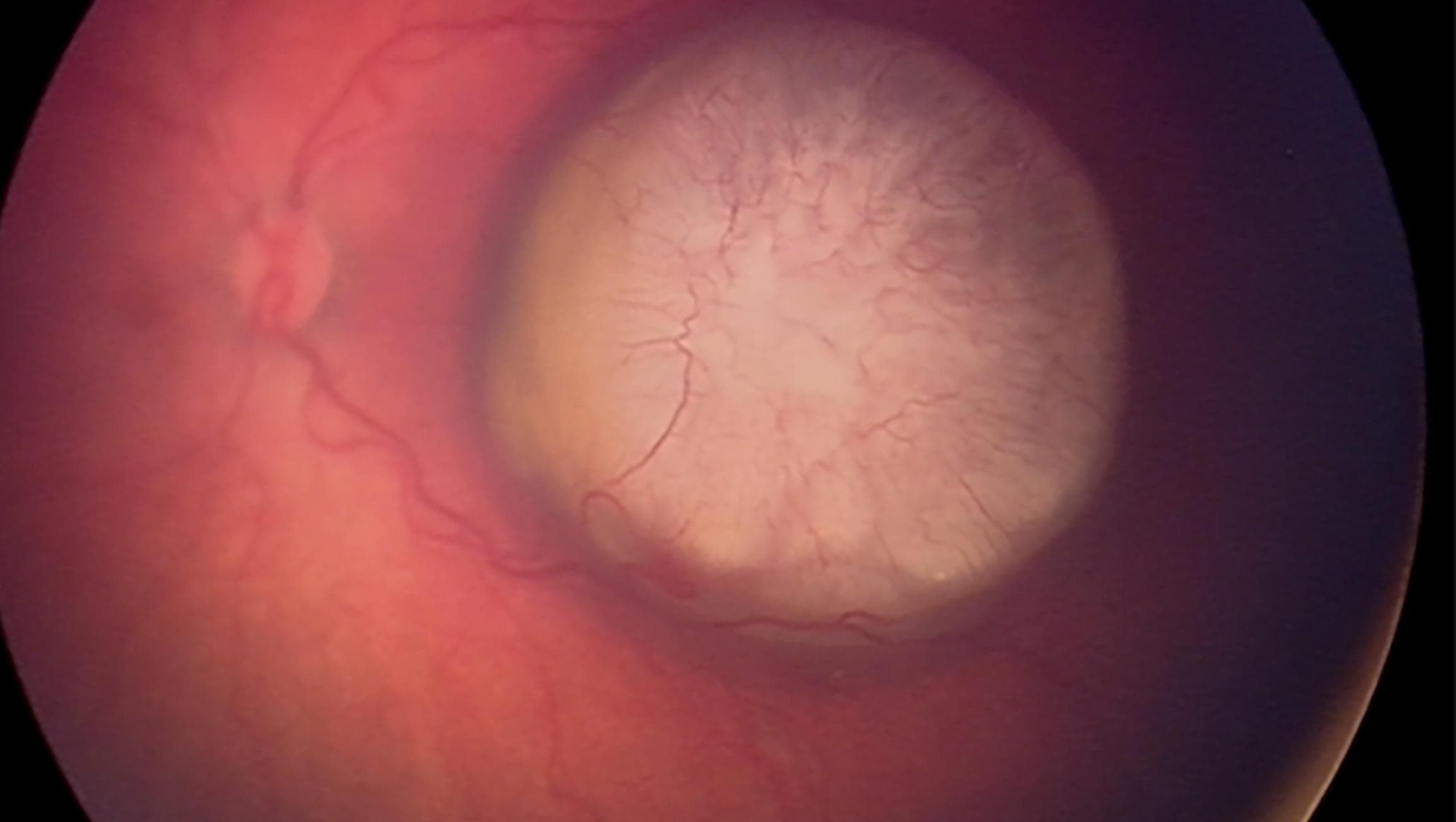 Could the Squint be a Sign?