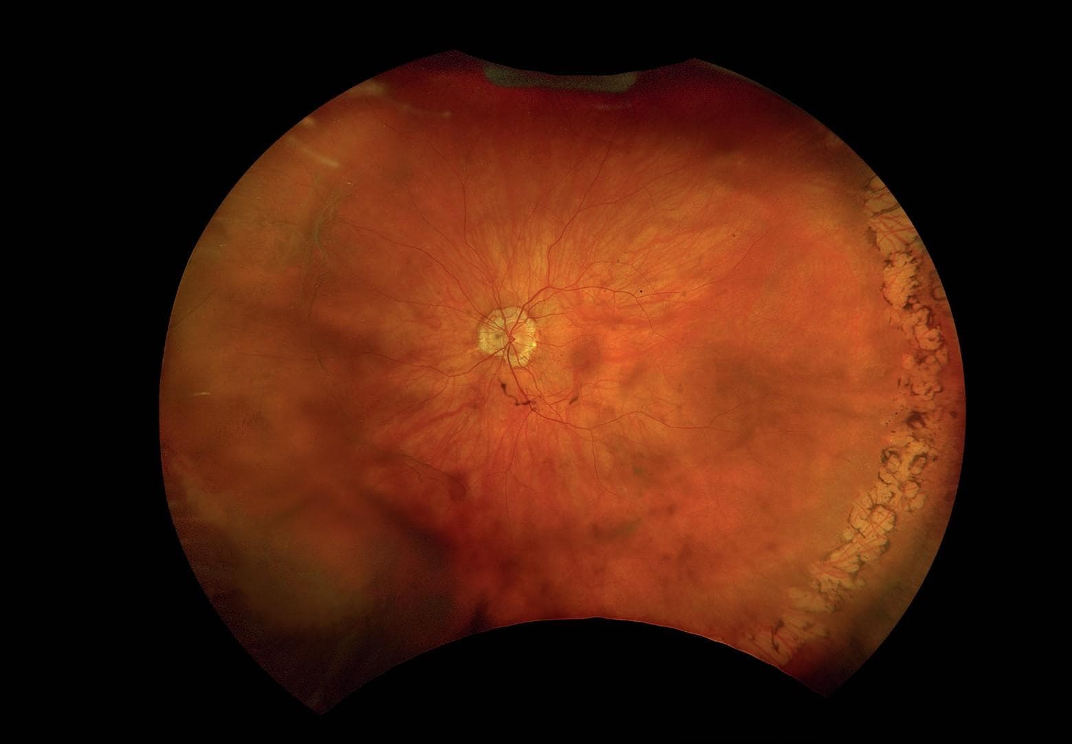 The Bigger Picture: Ultra-Widefield Imaging in Medical Retina Care