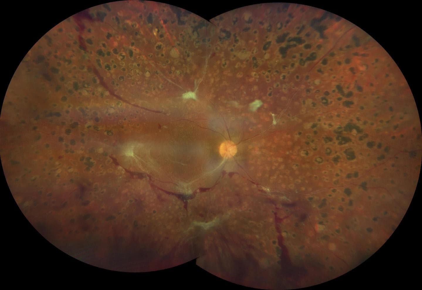 Proliferative Diabetic Retinopathy: A Practical Guide for Optometrists