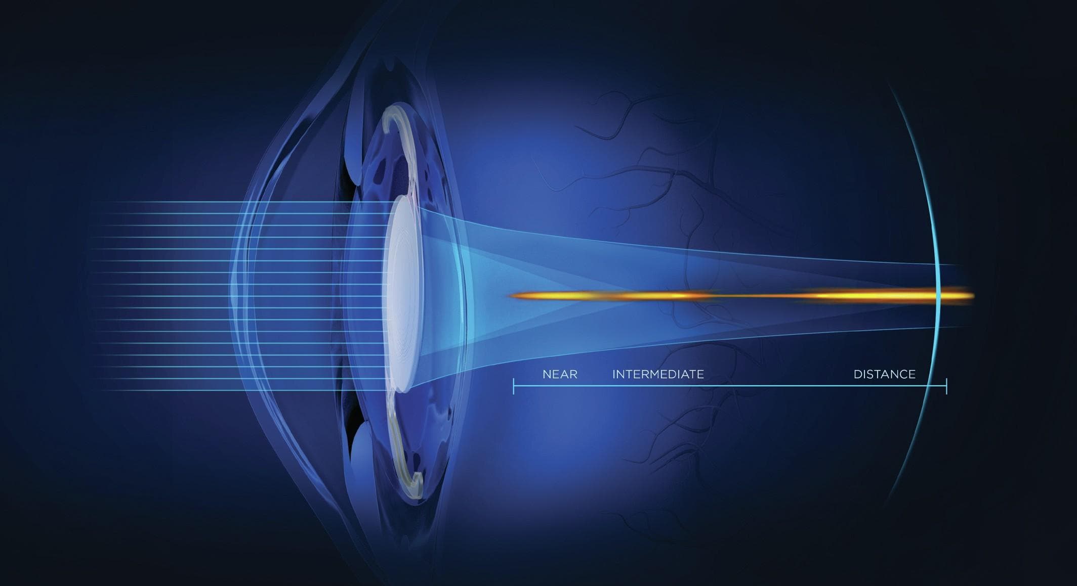 The IOL Redefining Full Range Vision