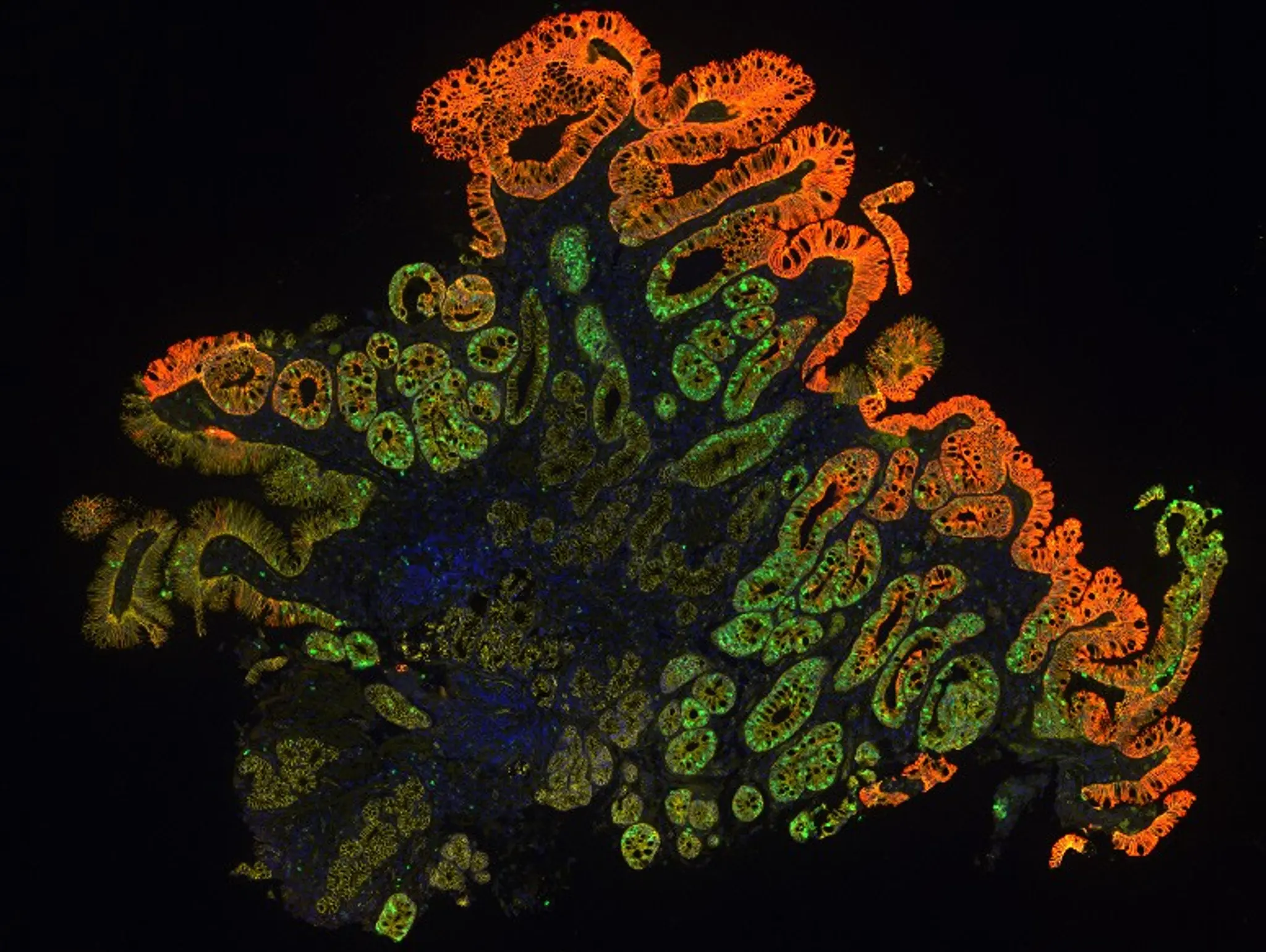 From sample to insight: how spatial biology is transforming cancer prognosis and clinical research