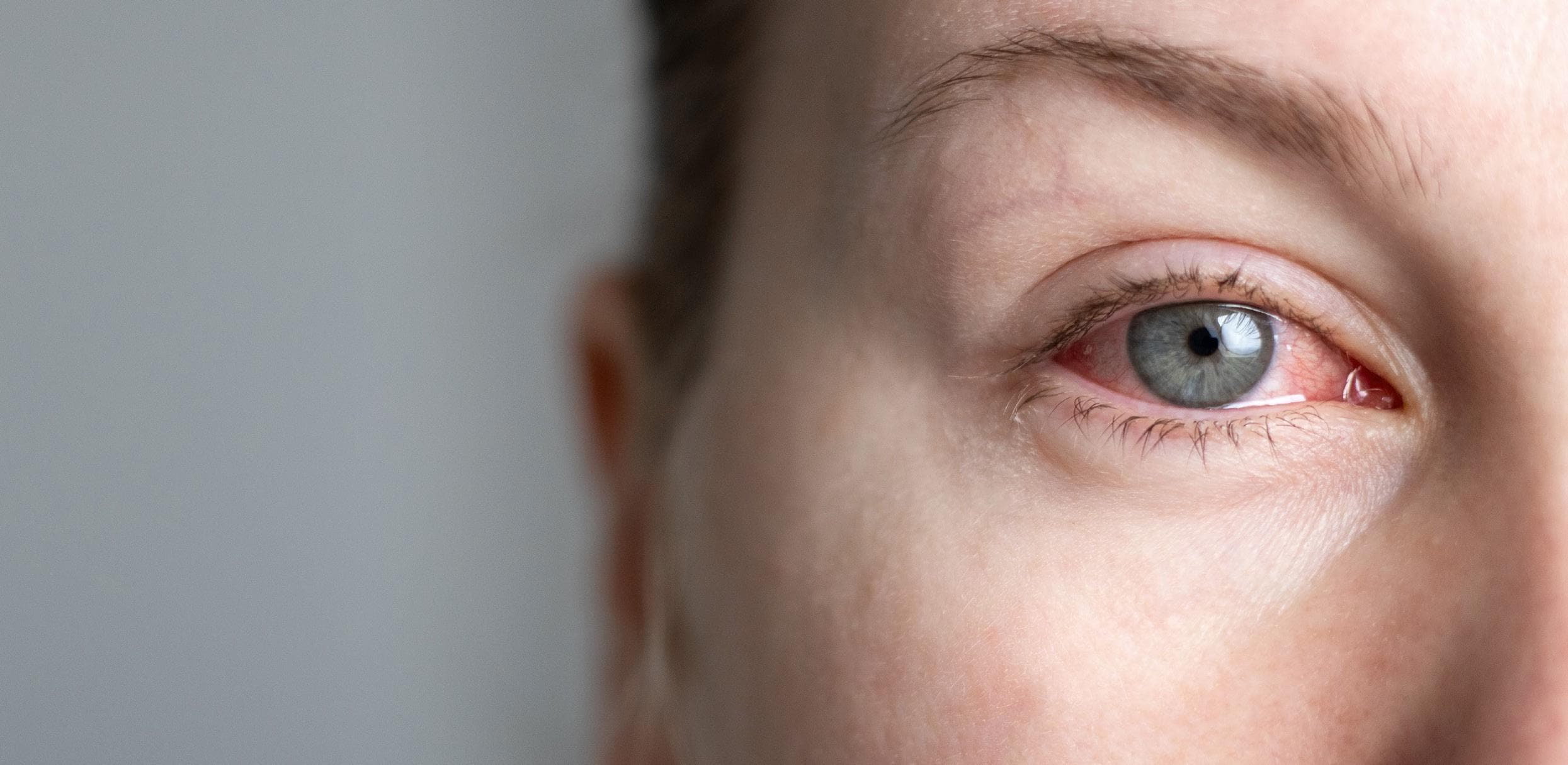The Allergic Eye