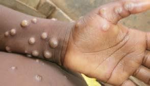 Monkeypox antiviral tecovirimat put to the test