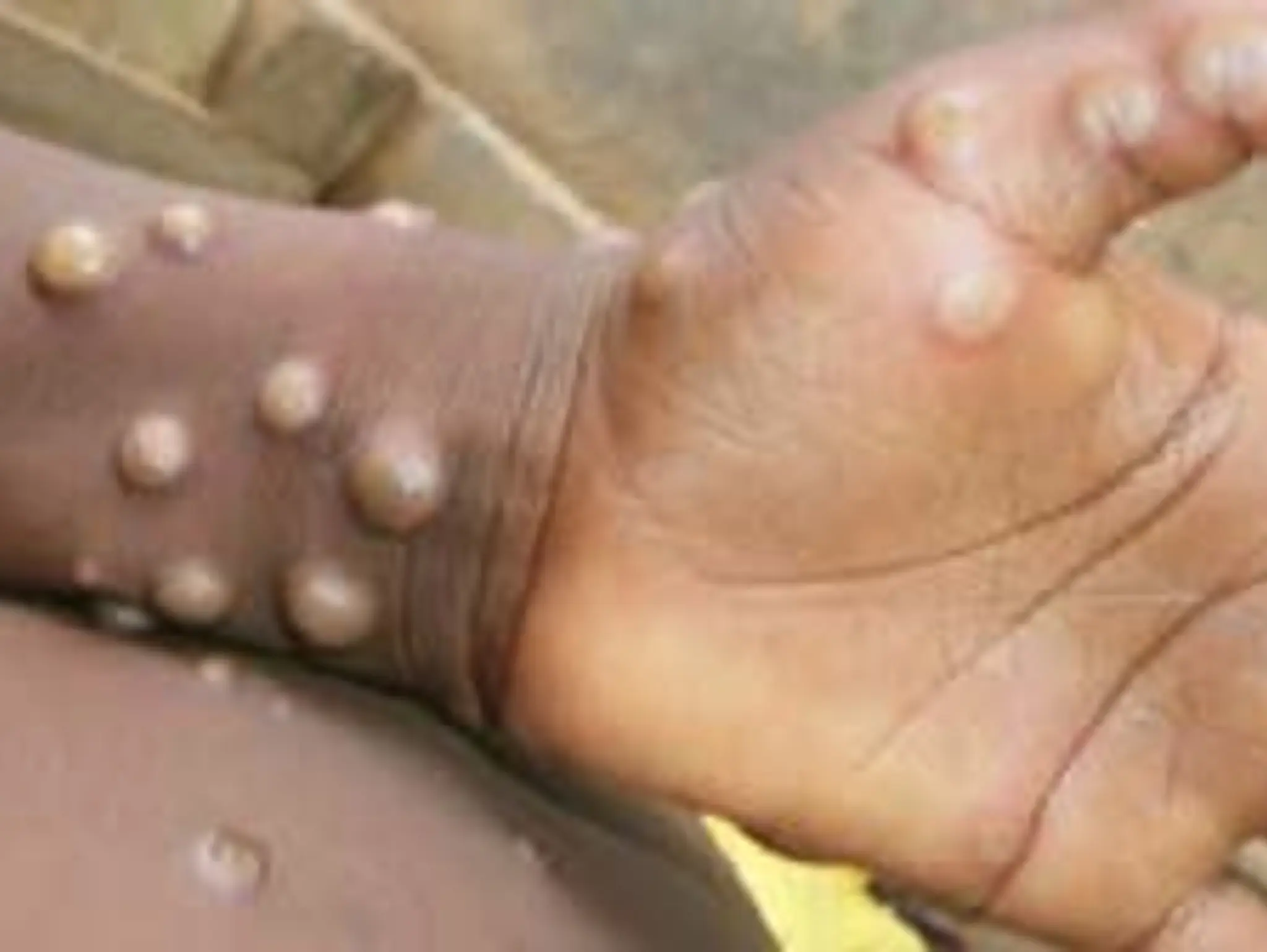 Monkeypox antiviral tecovirimat put to the test