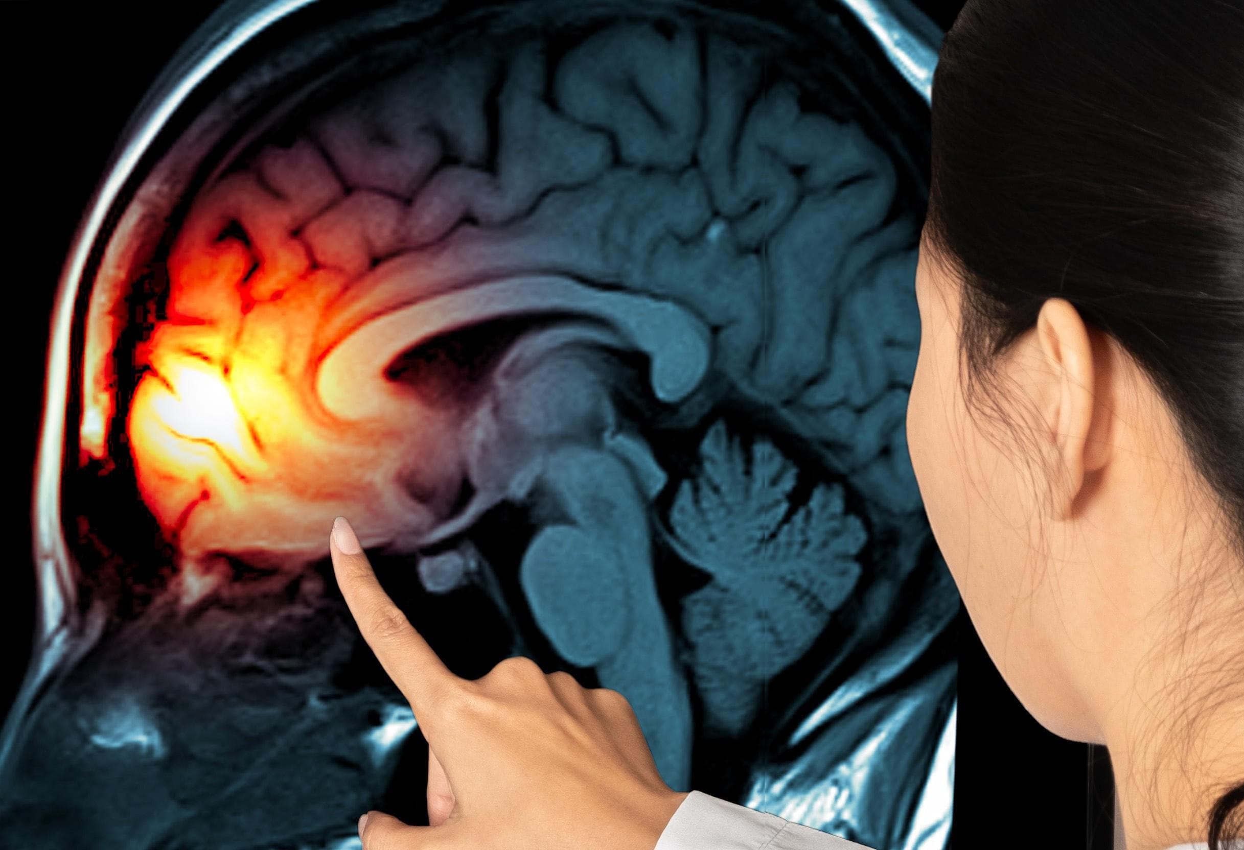 The importance of treating TBIs early