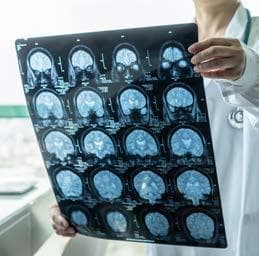 5 Neurological Phenomenons