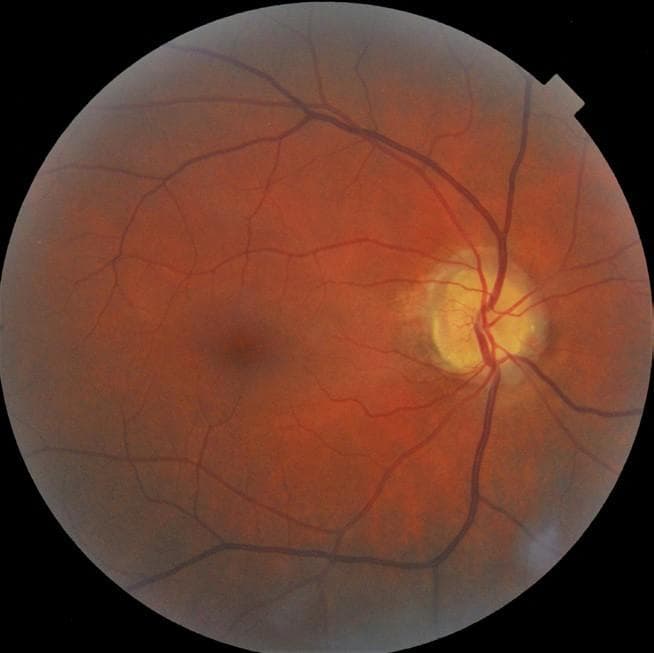 Navigating Visual Fields in Optic Nerve Head Drusen
